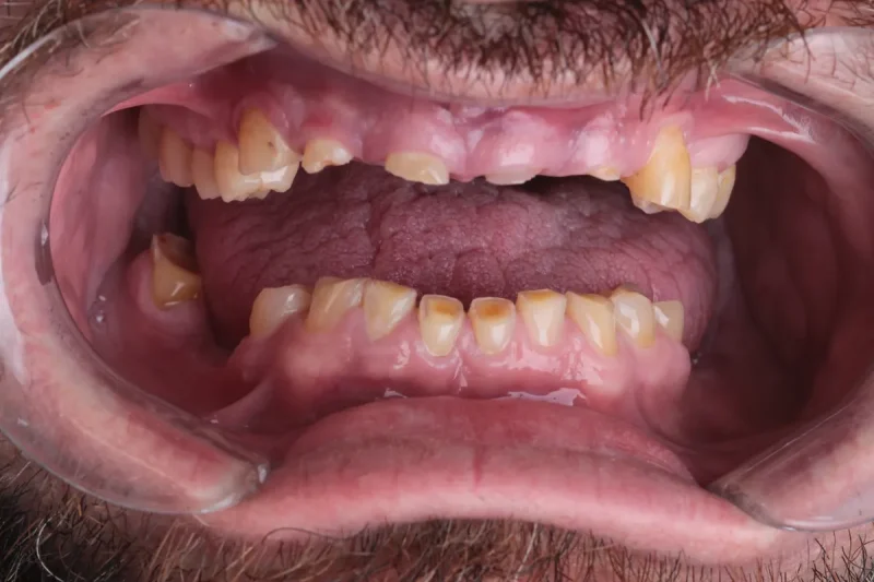 Art-Dental-Clinic-Costa-Rica-Before-and-After (4)