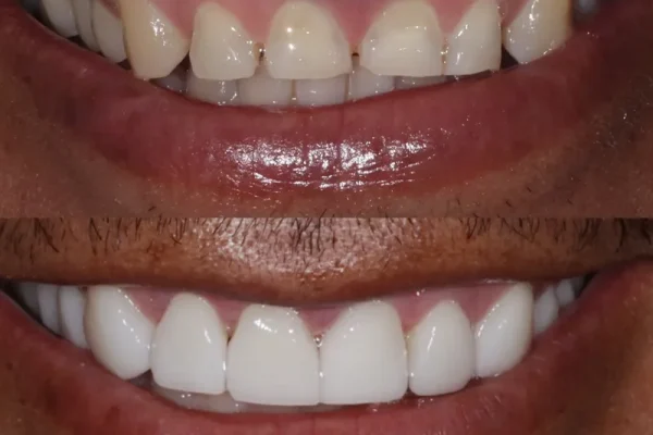 Dentica-Dental-Clinic-Bogota-Colombia-Before-and-After (2)