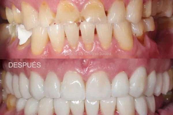 Dentica-Dental-Clinic-Bogota-Colombia-Before-and-After (3)