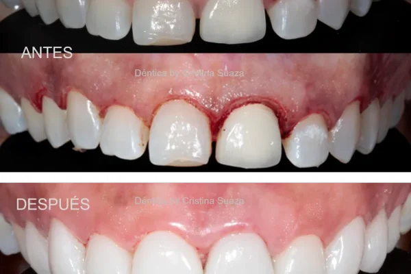 Dentica-Dental-Clinic-Bogota-Colombia-Before-and-After (4)