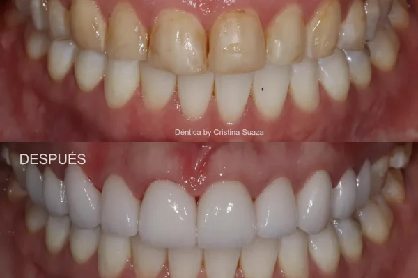 Dentica-Dental-Clinic-Bogota-Colombia-Before-and-After (8)