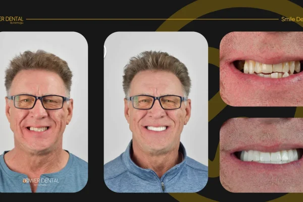 Tower-Dental-Clinic-Istabul-Turkey-Before-and-After (1)