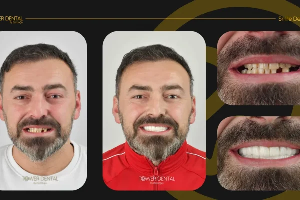 Tower-Dental-Clinic-Istabul-Turkey-Before-and-After (3)