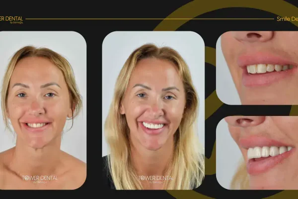 Tower-Dental-Clinic-Istabul-Turkey-Before-and-After (5)
